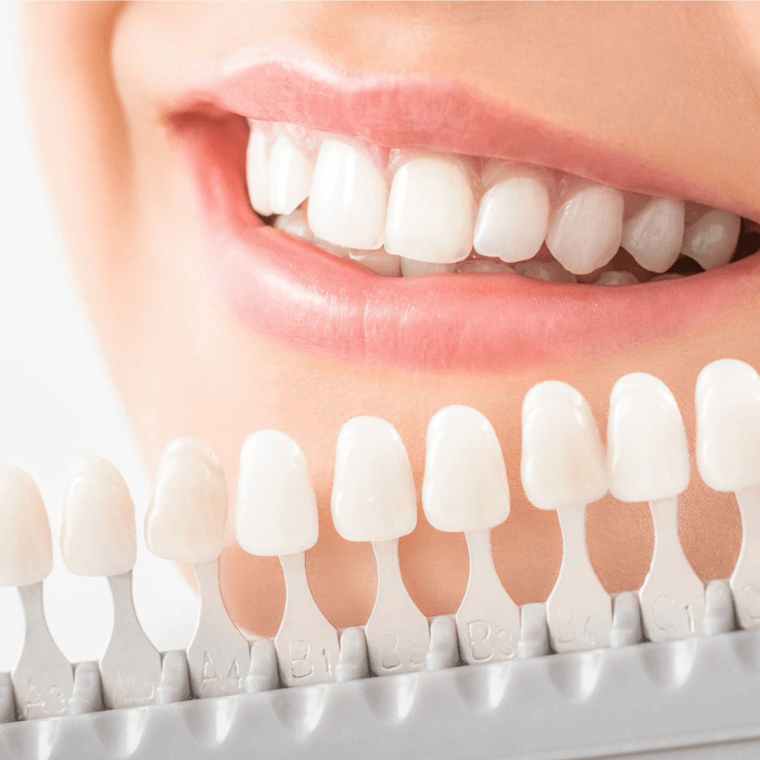 Ästhetische Zahnheilkunde – professionelles Bleaching für ein natürliches Lächeln