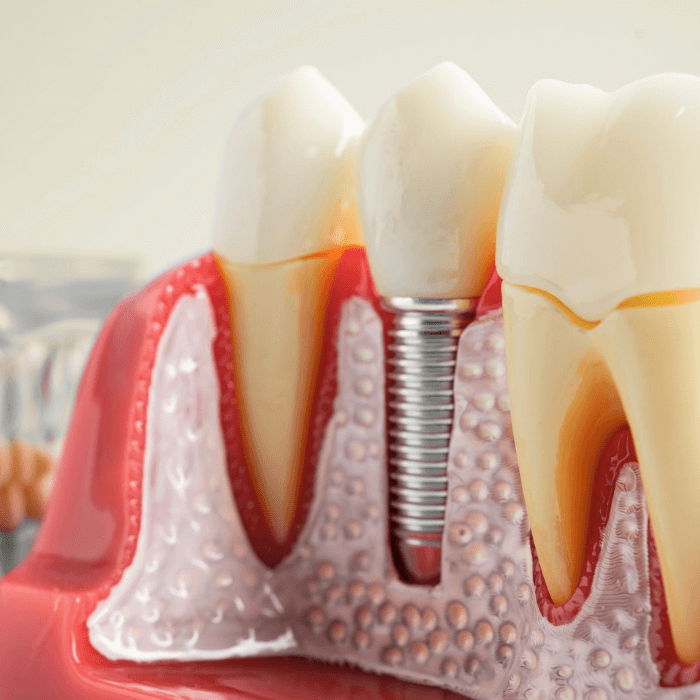 Zahnarzt bei oralchirurgischem Eingriff in der Praxis – Implantologie und Oralchirurgie